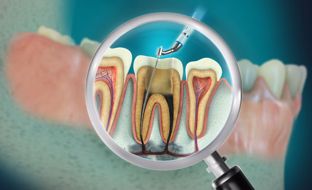 Root Canal Therapy: When It’s Needed & What to Expect