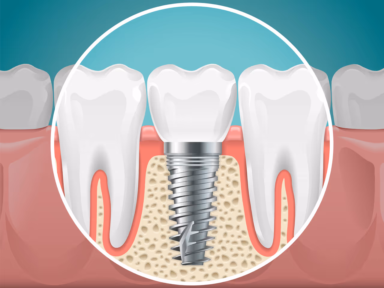 How Dental Implants Restore Your Smile and Functionality